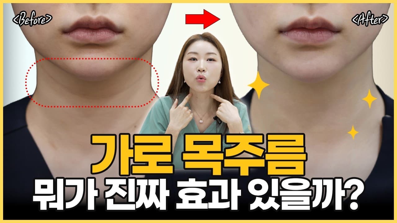 굵은 가로 목주름, 왜 안 없어질까요? 목주름 필러 전후 변화로 설명드립니다